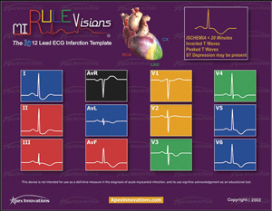 MI Rule Visions: The 3D 12-Lead ECG Infarction Template